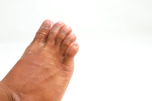 Close-up of a person's bare foot against a white background, showcasing skin texture and toes photo
