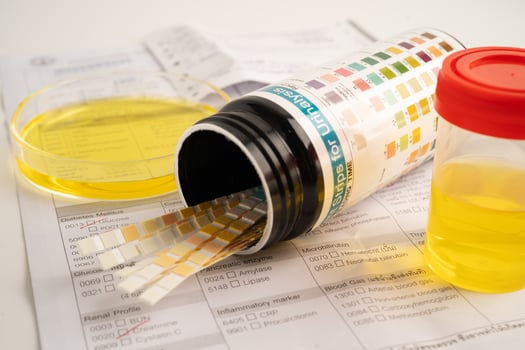 Urinalysis, urine cup reagent strip pH paper test and comparison chart in laboratory. photo