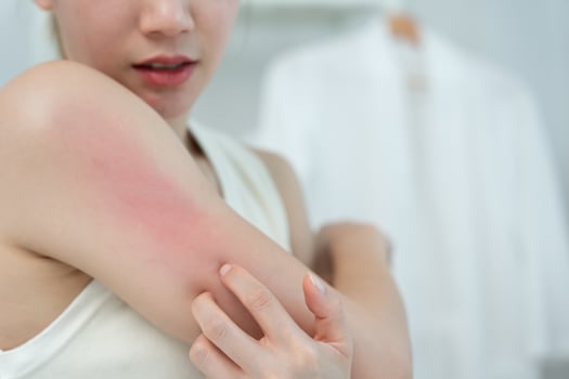 skin problem and beauty, woman scratch body has itchy skin from skin allergic, steroid allergy, sensitive skin, red from sunburn, chemical allergy, rash, insect bites Seborrheic Dermatitis photo
