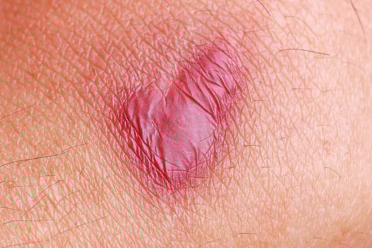 Scar on skin for pattern photo