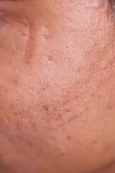 Skin texture showing imperfections and blemishes in close-up photo