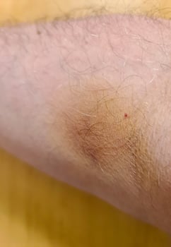 Bruise forming on man arm after receiving intravenous therapy photo