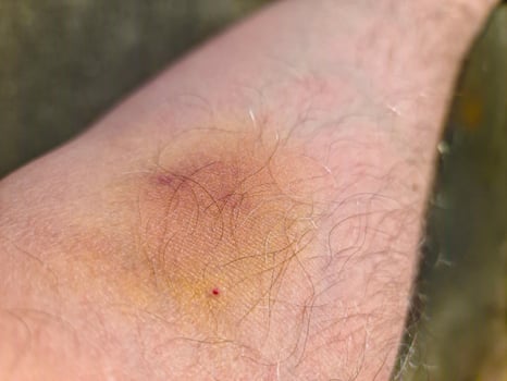 Large bruise forming on hairy arm after injection photo