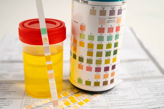 Urinalysis, urine cup with reagent strip pH paper test and comparison chart photo