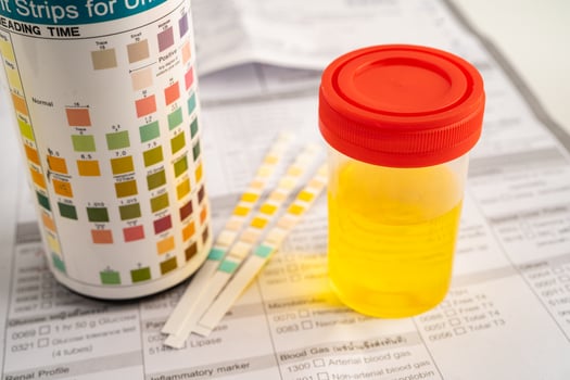 Urinalysis urine cup with reagent strip pH paper test comparison chart photo