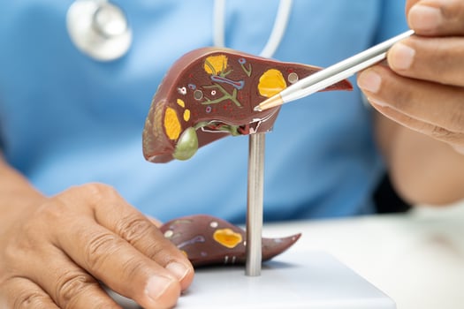 Cirrhosis, Liver cancer fatty liver, Asian doctor with liver human anatomy model in World Hepatitis Day at hospital. photo