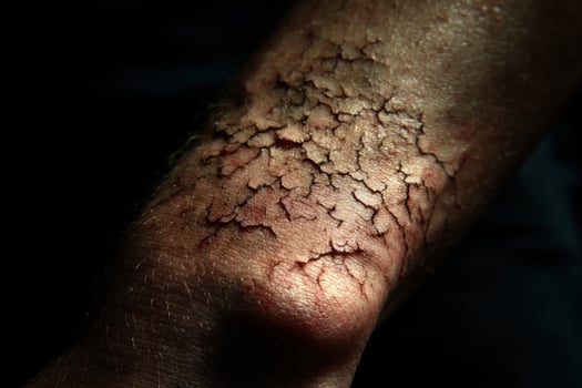 A person with a rash on their arm photo