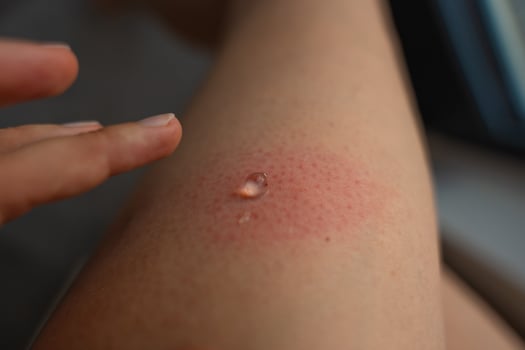 Applying gel to swollen red wasp sting on woman leg with allergic skin reaction photo