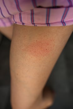 Red swollen spot on womans leg after insect sting or allergic skin reaction photo