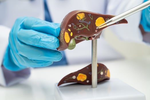 Cirrhosis, Liver cancer, fatty liver, Asian doctor with liver human anatomy photo