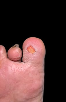 Closeup of Diabetic Foot Ulcer on Big Toe photo