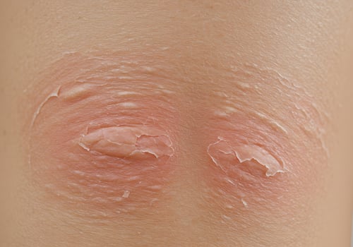 Closeup skin irritation on knees photo