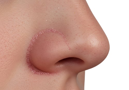 Nose skin discoloration closeup photo