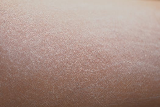 Dry Skin texture close-up showing natural details and patterns photo