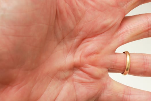 Man with Dupuytren Contracture on the palm of his hand photo