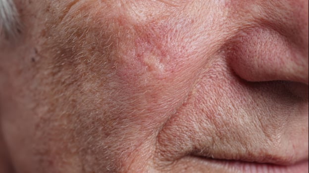 Dermatological view of cheek skin exhibiting clustered open comedones emphasizing darkened sebum oxidization on surface photo