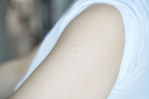 Close up of bare caucasian skin with small square mark on upper arm in soft light. photo