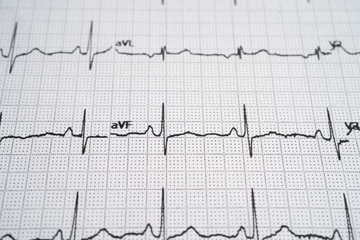 Electrocardiogram ECG, heart wave, heart attack, cardiogram photo
