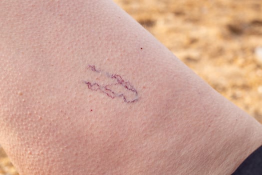 Blue veins spider veins on the leg. Telangiectasias, dilated capillaries showing through the skin photo
