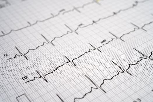 Red heart on electrocardiogram ECG with red heart, heart wave, heart attack, cardiogram photo