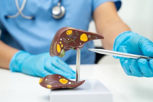 Cirrhosis, Liver cancer, fatty liver, Asian doctor with liver human anatomy model in World Hepatitis Day photo