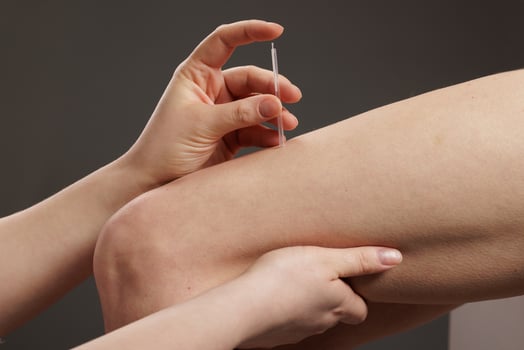 Dry Needling Therapy for Muscle Pain Relief, Trigger Point Physiotherapy and Rehabilitation photo