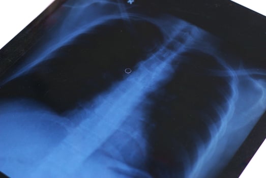 x ray image of a chest and lungs photo