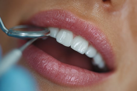 A woman is getting her teeth cleaned with a dental tool photo