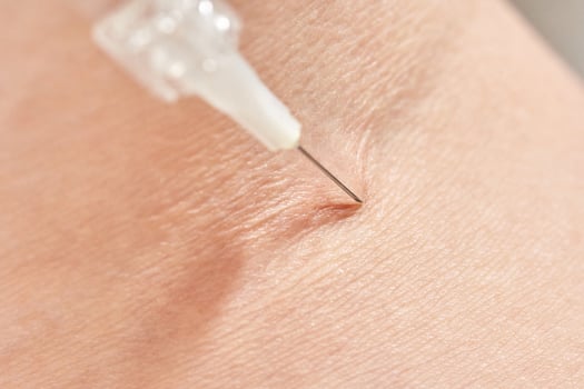 close up of needle inserting into caucasian adult skin for medical procedure. photo