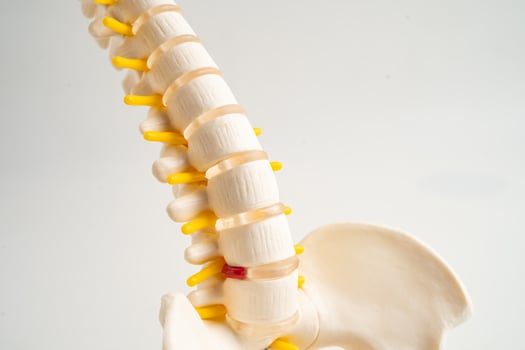 Spinal nerve and bone, Lumbar spine displaced herniated disc fragment, Model for treatment medical in orthopedic photo