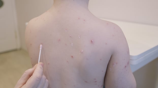 Child Suffering from Skin Condition chickenpox Accompanied by Lesions Present on Their Back photo
