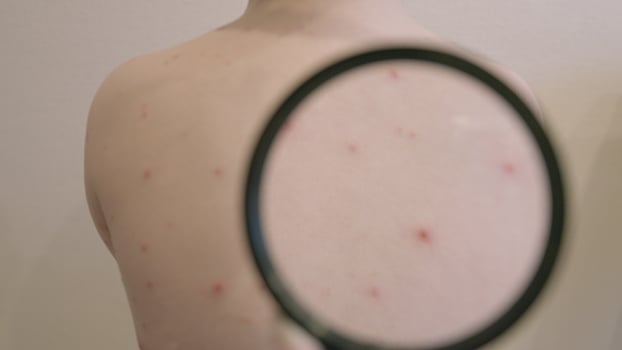 CloseUp Observation of Skin Featuring chickenpox Bumps Under a Magnifying Glass Lens photo