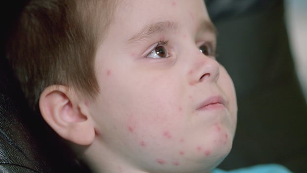 A young child exhibiting skin rash chickenpox symptoms that raise concerns requiring attention photo