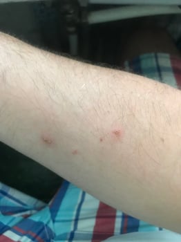 Skin irritation on a forearm after outdoor activity photo