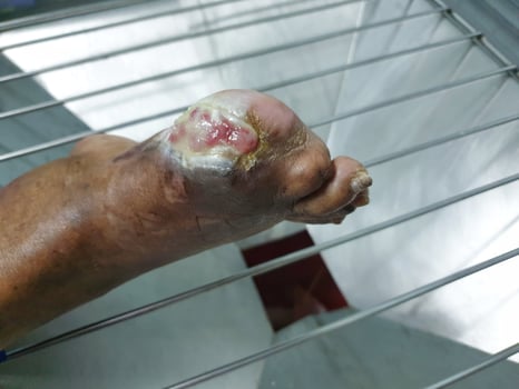 A person with a swollen foot in a hospital bed photo