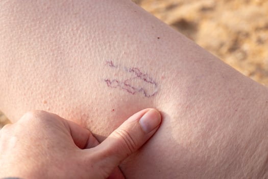 woman examines blue spider veins on her leg. Telangiectasias, dilated capillaries showing through the skin photo