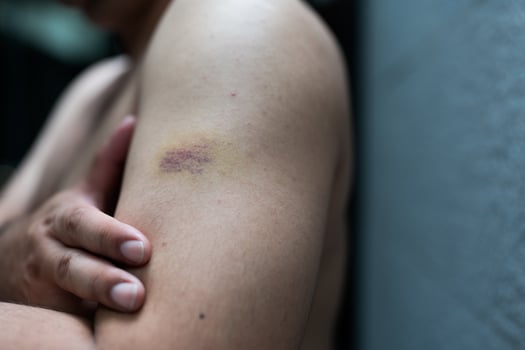 Purple bruise on the arm from accident photo