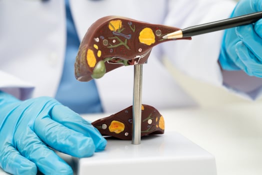 Cirrhosis, Liver cancer, fatty liver, Asian doctor with liver anatomy model photo