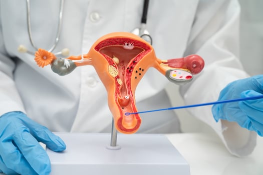 Doctor holding human uterus model for vaginal and cervix pap smear check up in the obstetrics and gynecology. photo