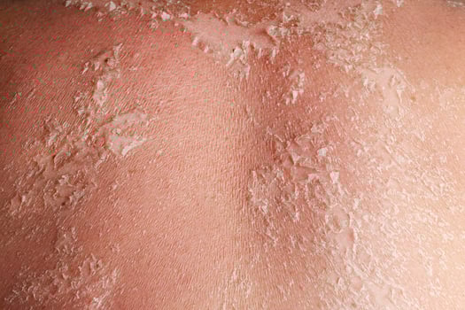 Sunburn on the skin. Skin from the burn texture. Dry skin in need of treatment and hydration. Close up photo