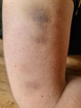 Large bruise showing on upper arm skin photo