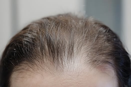 Close Up of Thinning Hair and Receding Hairline. photo