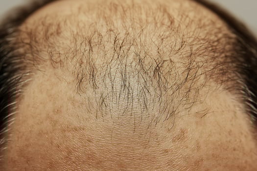 Extreme Close Up of Human Scalp Showing Thinning Hair Growth and Skin Texture. photo