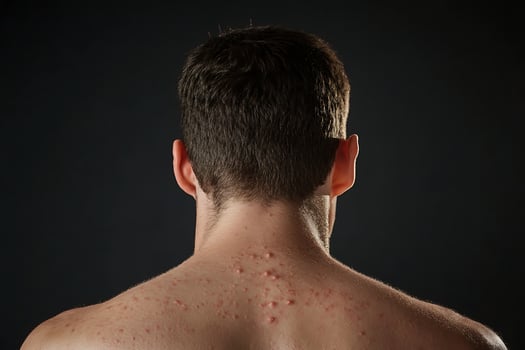 Man's Back and Neck with Acne and Skin Imperfections. photo