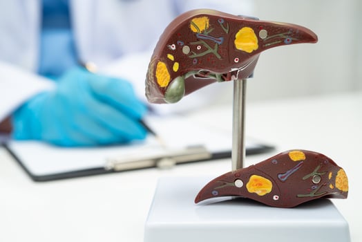 Cirrhosis, Liver cancer, fatty liver, Asian doctor with liver human photo