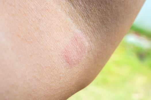 A person with a small patch of skin on their arm photo