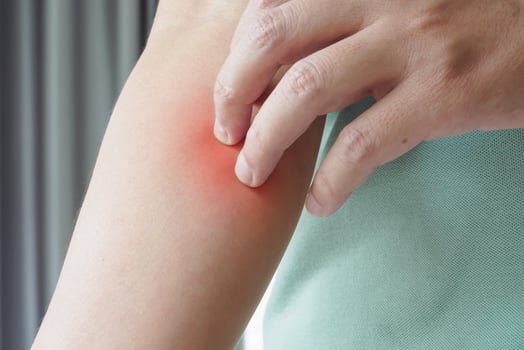 A person with a red spot on their arm photo