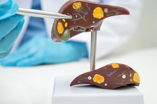 Cirrhosis, Liver cancer, fatty liver, Asian doctor with liver human anatomy model in World photo