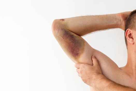 Injury on arm reveals bruising and swelling after an accident or impact photo