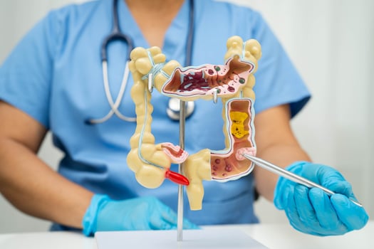 Intestine, Asian woman holding photo